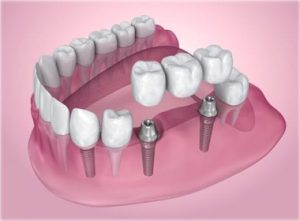 trồng răng phương pháp Implant