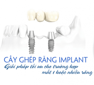 cam ghep implant min