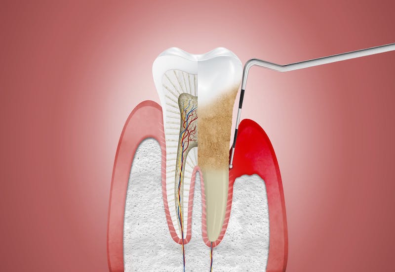 Tại sao nên điều trị bệnh nha chu sớm ?