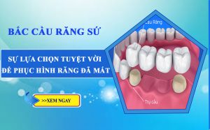 bắc sầu răng sứ