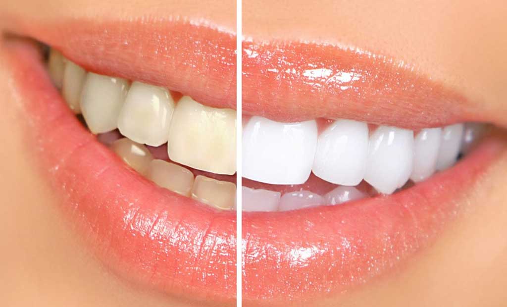 Quy trình tẩy trắng răng tại Hệ Thống Nha Khoa Hoàn Mỹ Sài Gòn