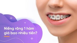 Niềng răng 1 hàm giá bao nhiêu