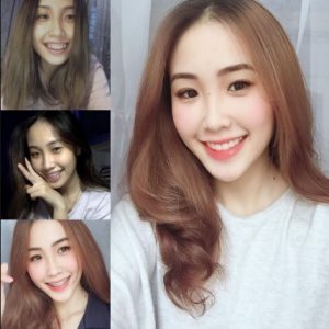 Niềng răng thay đổi góc nghiêng không