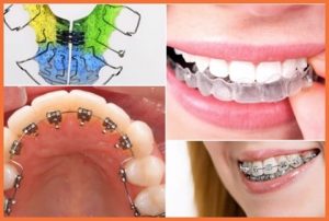 Niềng răng tốt không