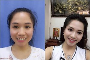 Niềng răng thay đổi nhan sắc