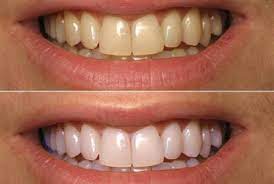 Nguyên nhân gây hôi miệng và vàng răng