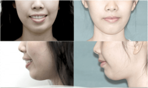 Niềng răng có làm thay đổi khuôn mặt không