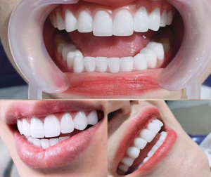 Làm răng sứ thẩm mỹ ở đâu đẹp nhất hiện nay