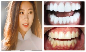 Review bọc răng sứ thẩm mỹ