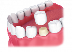 RĂNG SỨ THẨM MỸ