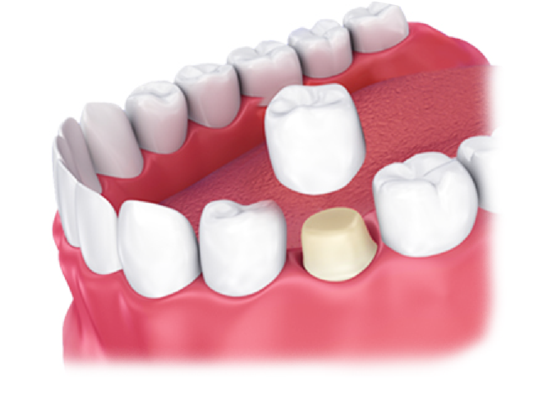 RĂNG SỨ THẨM MỸ