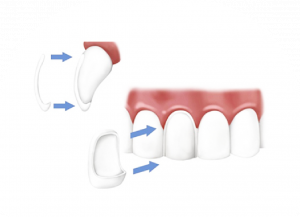 DÁN SỨ VENEER