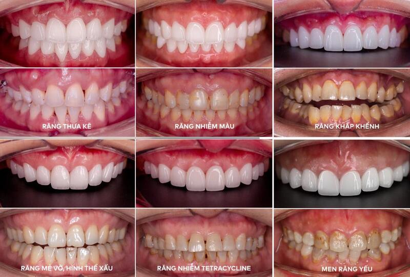 Mặt dán sứ Emax khắc phục tình trạng răng ố vàng, khấp khểnh