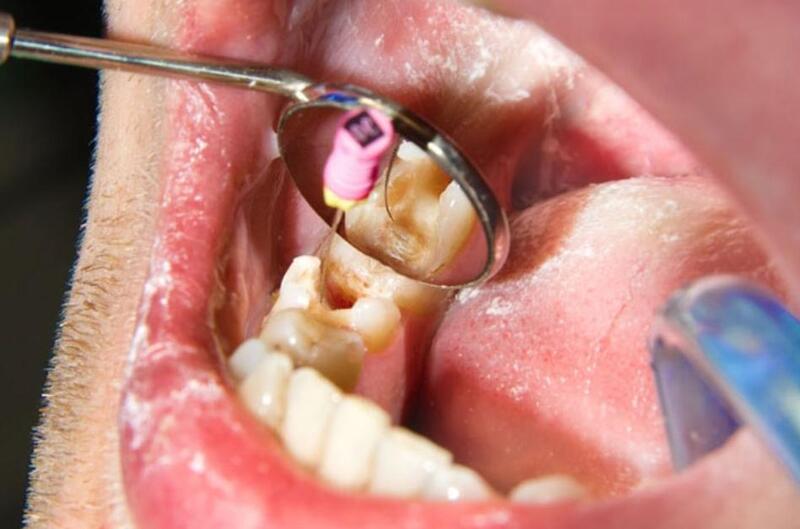 Vị trí răng và mức độ viêm nhiễm ảnh hưởng đến chi phí lấy tủy