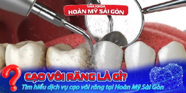 cạo vôi răng