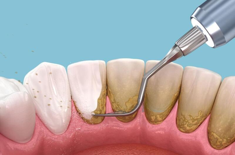 cạo vôi răng đánh bóng