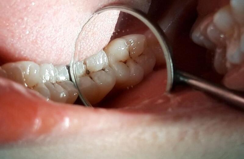 Tủy răng đã chết thường không còn cảm giác đau nhức