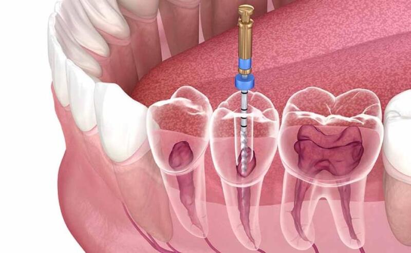 Bệnh lý tủy răng khi không được chữa trị sớm có thể trở nên nghiêm trọng và lây lan