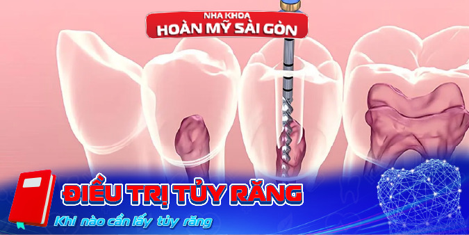 điều trị tủy răng