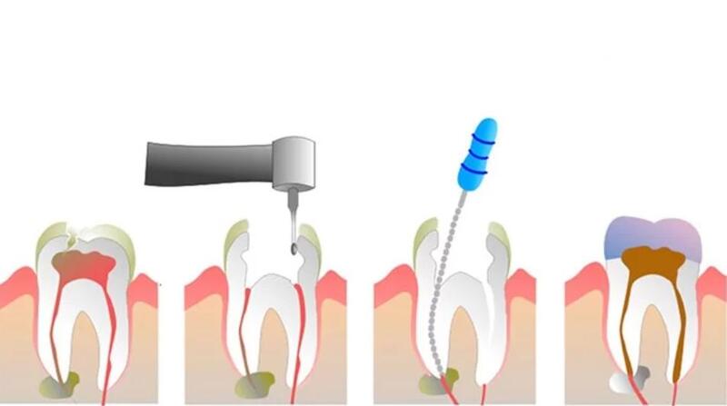 Quy trình điều trị răng chết tủy