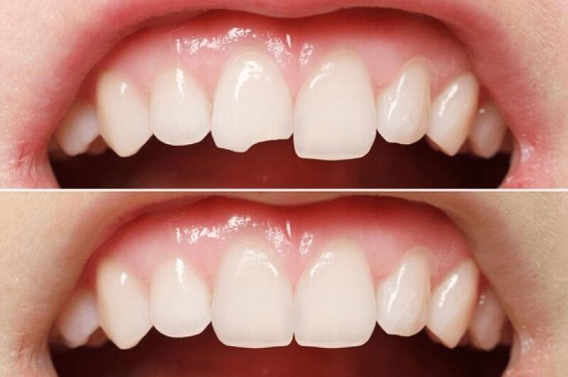 khi nào cần trám răng thẩm mỹ