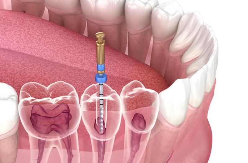 Kỹ thuật lấy tủy răng