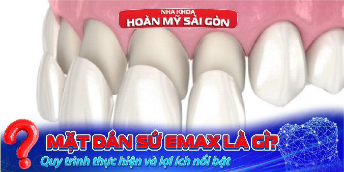 Mặt dán sứ Emax