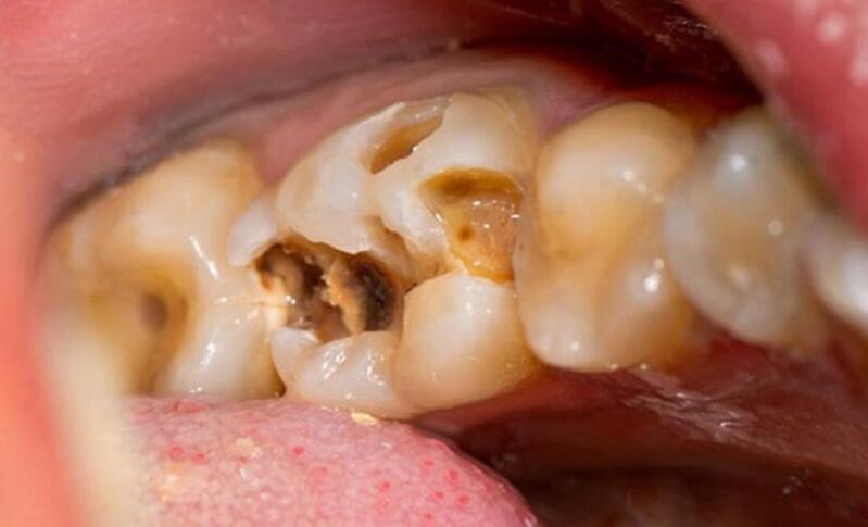 Ăn quá nhiều đồ ngọt dẫn đến sâu răng gây ra viêm tủy răng