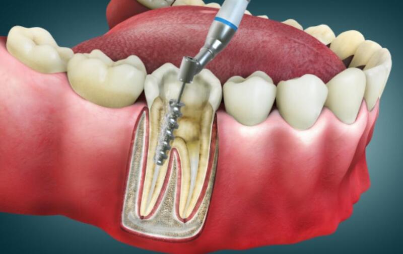 Nếu viêm tủy không hồi phục, có thể phẫu thuật cắt tủy để cứu răng