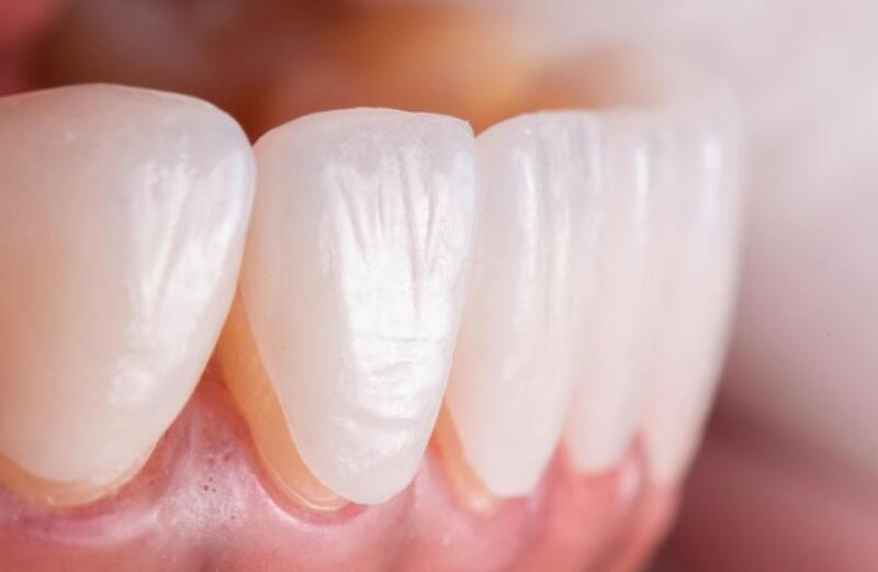 Răng sứ Zolid đẹp tự nhiên không khác gì răng thật