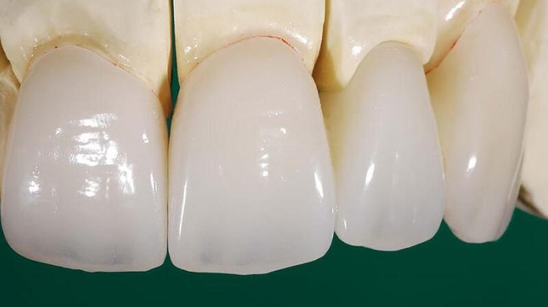 Răng sứ Zolid được rất nhiều khách hàng ưa chuộng 