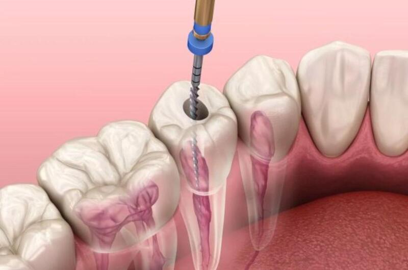 tầm quan trọng của việc điều trị tủy răng