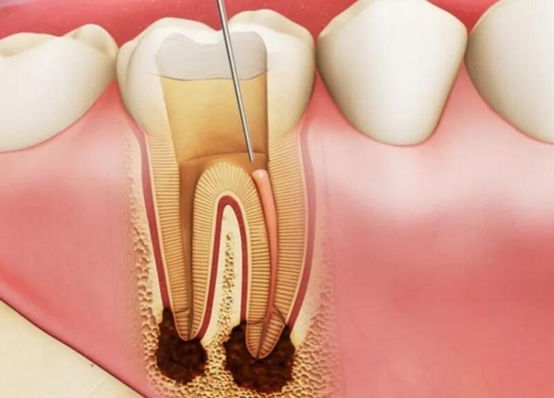 Viêm tủy răng xảy ra khi vùng tủy và mô xung quanh chân răng bị viêm nhiễm