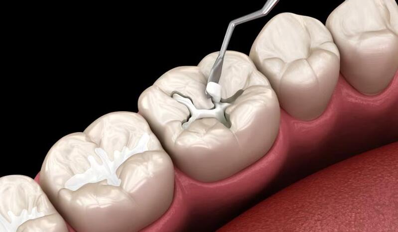 trám răng thẩm mỹ