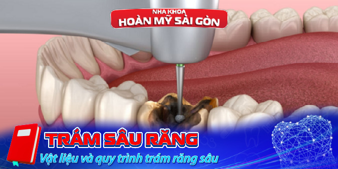 Trám răng sâu