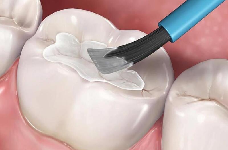 trám răng thẩm mỹ bằng GIC