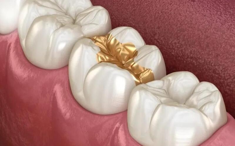 trám răng thẩm mỹ bằng quý kim