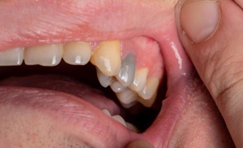 Nếu được chữa trị kịp thời, răng có thể duy trì được từ 15 - 20 năm