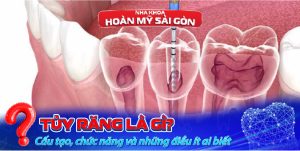 tủy răng là gì