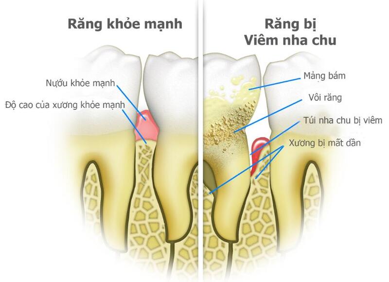Bệnh viêm nha chu có thể làm cho răng bị hoại tử