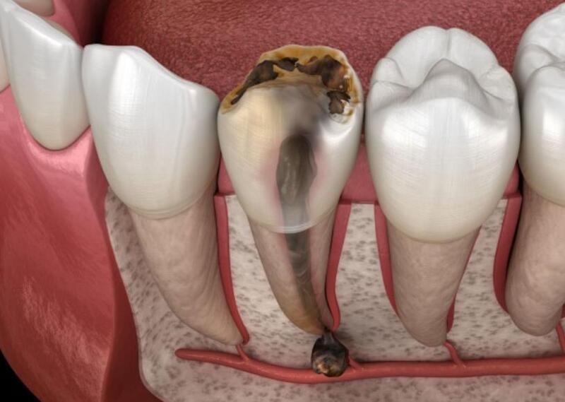 Viêm tủy răng là bệnh lý thường gặp nhất