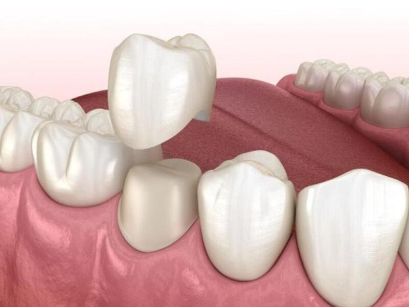 bọc răng sứ có đau không