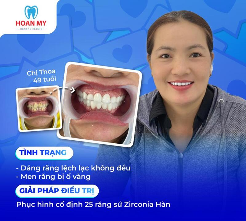 Khách hàng bọc răng sứ thẩm mỹ, khắc phục tình trạng răng lệch lạc