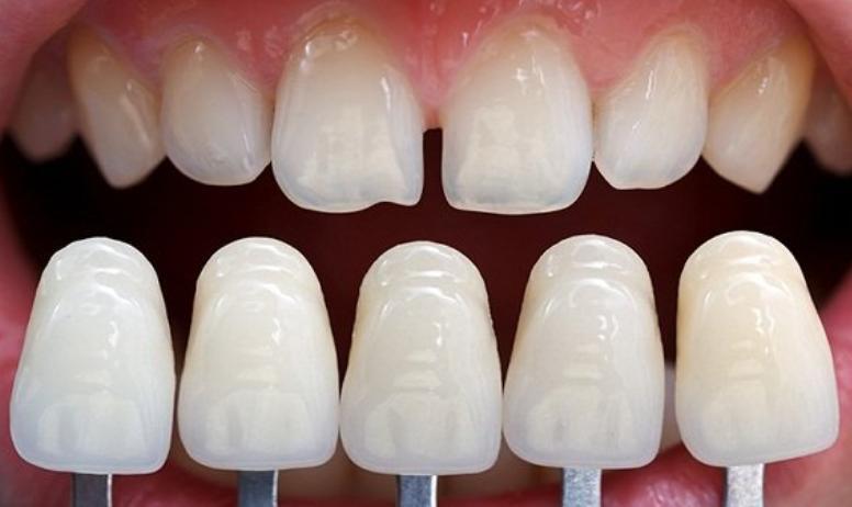 Bọc răng sứ giúp cải thiện răng thưa, đẹp như răng thật