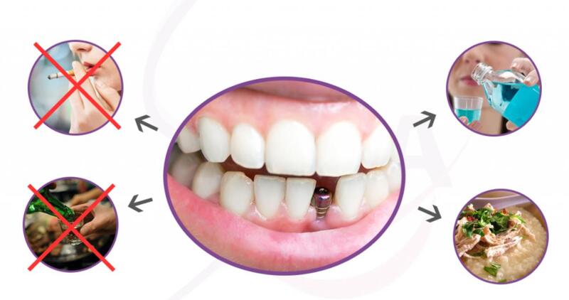 Một số lưu ý chăm sóc răng miệng sau khi phục hình