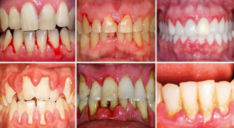 dấu hiệu nhận biết viêm nha chu