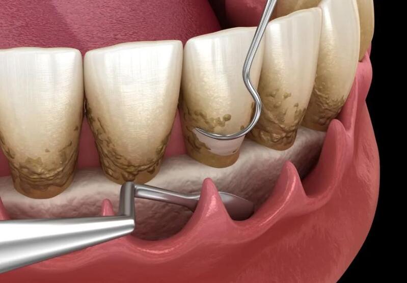 điều trị nha chu không phẩu thuật