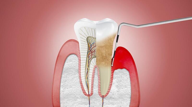 điều trị nha chu