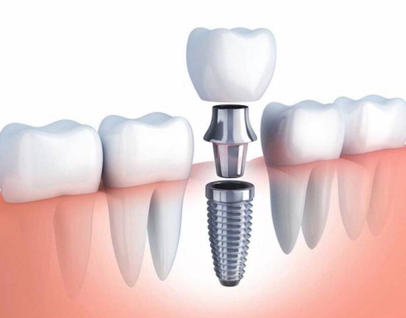 Gắn Abutment và răng sứ lên implant