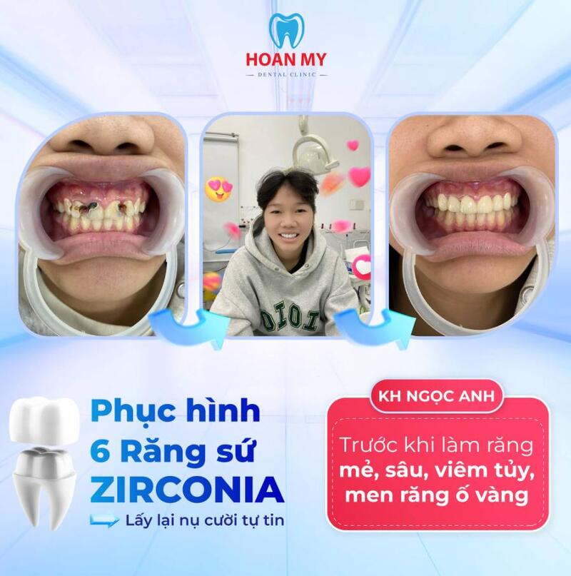 Khách hàng điều trị tủy răng tại Nha Khoa Hoàn Mỹ Sài Gòn